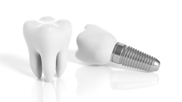 Dental Implants vs Dentures – Understanding the Differences